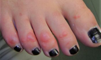 Chilblains